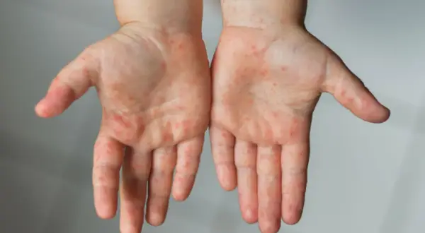 Dłonie dziecka pokryte czerwonymi kropkami, objaw uczulenia na chlor po kąpieli w basenie.